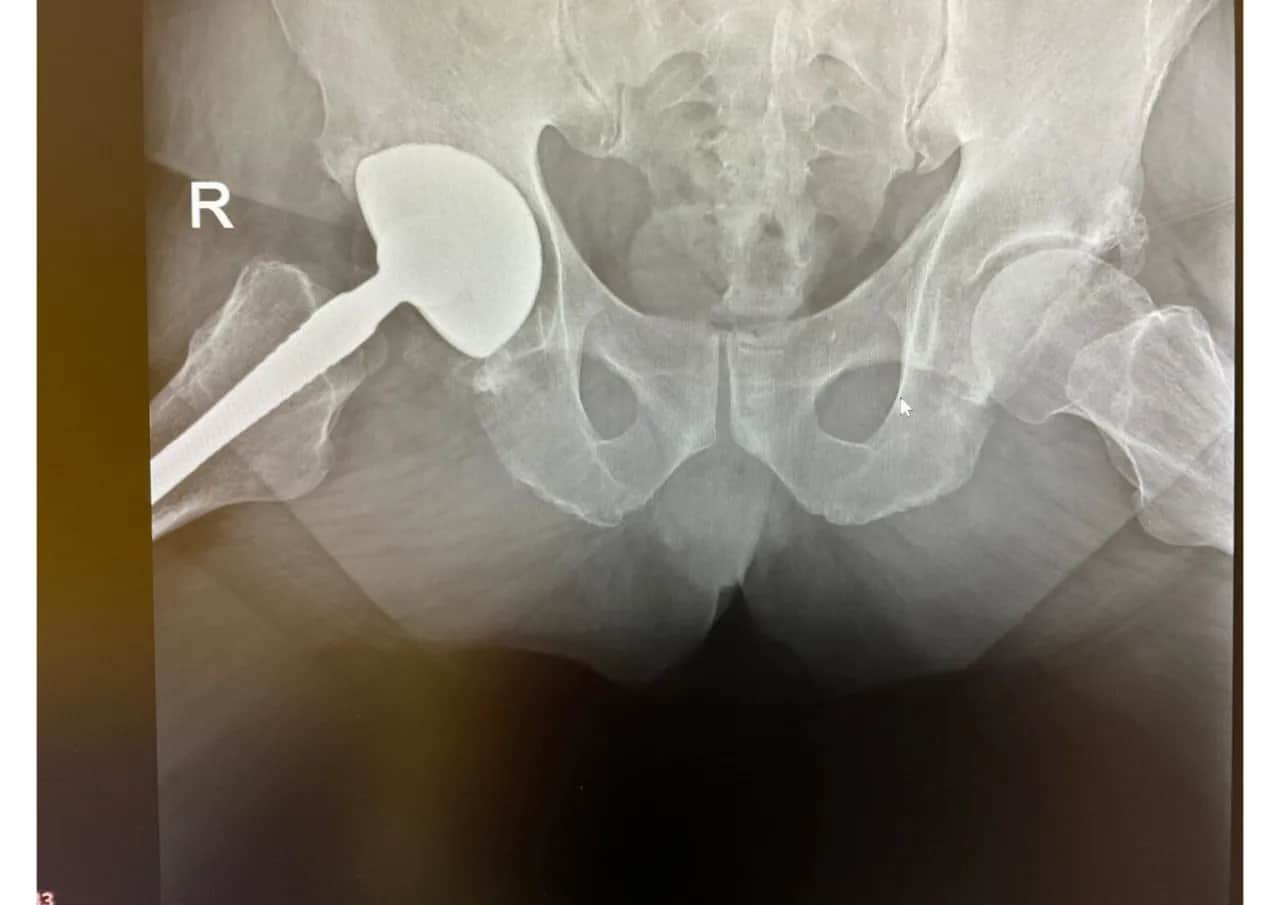Endoproteza stawu biodrowego nfz gdzie najlepiej – wybierz mądrze