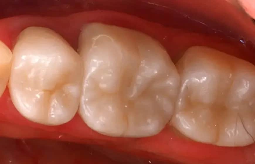 Ile kosztuje biała plomba na NFZ? Sprawdź, co musisz wiedzieć